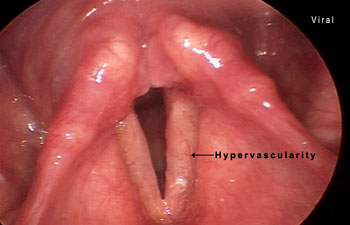Acute Laryngitis