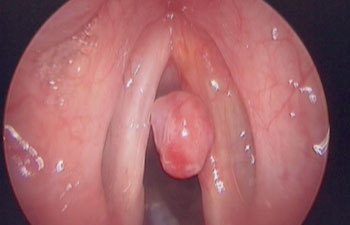 Vocal Cord Polyp