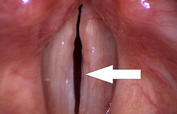 Suclus Treatment in Mumbai